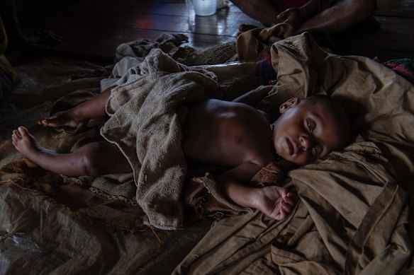 Baby with club foot at Mougulu Medical Centre ward, Mougulu village.