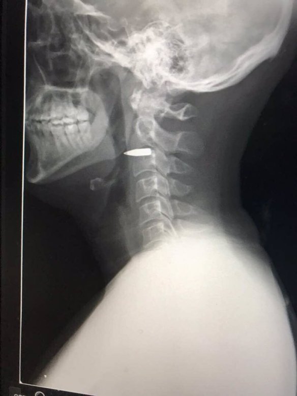 A close shave: The bullet lodged in Adam Harvey's neck. 