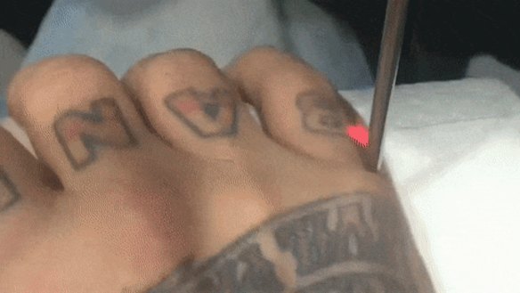 Toby Mitchell has his Bandidos tattoo removed.