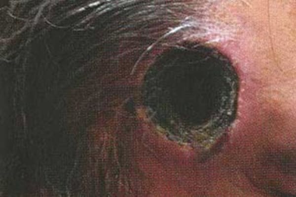 brisbane treatment skin warning treatment salve' 'black over bogus Skin cancer