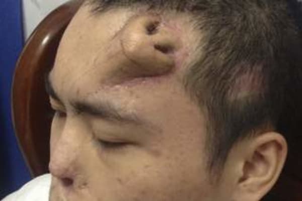 New nose grown on man's forehead