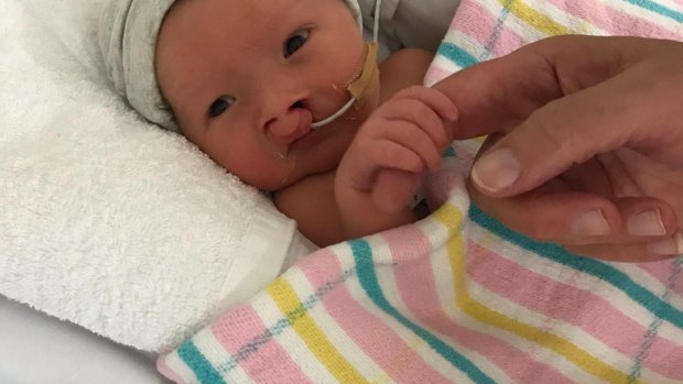 One-day-old Riley Bell with a nasal gastric tube used to feed him for three weeks. 