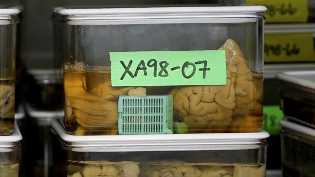 Slices of human brains that researchers at Northwestern University Chicago campus are using to study Alzheimer's disease.