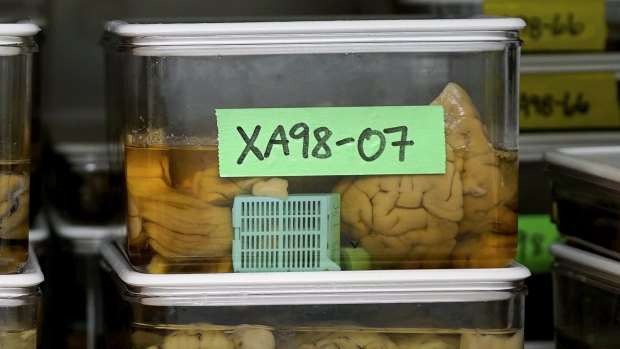 Slices of human brains that researchers at Northwestern University Chicago campus are using to study Alzheimer's disease.