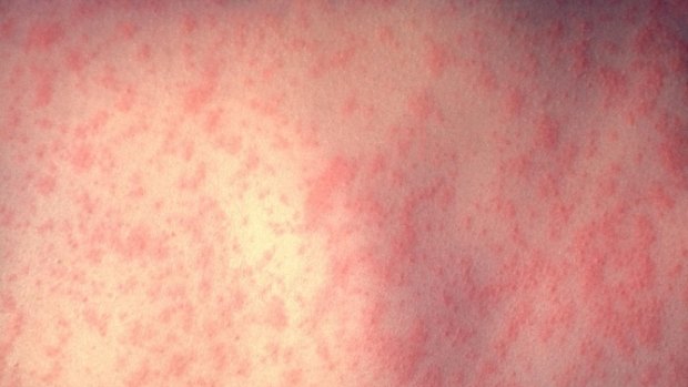 A typical measles rash.