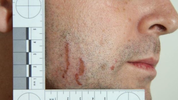 A photograph showing the scratches on Gerard Baden-Clay's face.