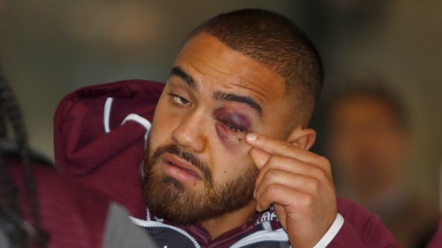 Shiner: Dylan Walker bears the scars of an altercation with Curtis Scott.