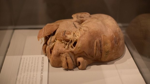 An exhibit from the Real Bodies exhibition, now showing in Sydney.