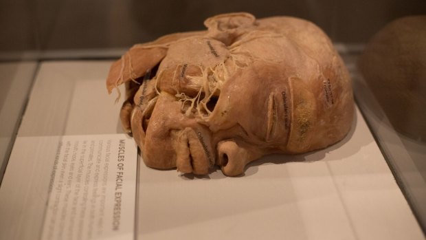 An exhibit from the Real Bodies exhibition, now showing in Sydney.