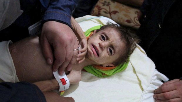 A severely malnourished child at the al-Kahef hospital in Kafr Batna, Eastern Ghouta near Damascus, Syria, last year.