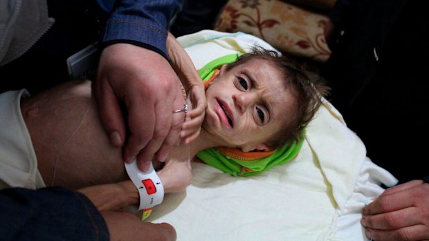 A severely malnourished child at the al-Kahef hospital in Kafr Batna, Eastern Ghouta near Damascus, Syria, last year.