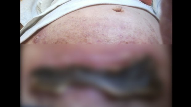 Fairfax Media was provided with an image of the wound on Helen Lawson's stomach after she tried to treat her ovarian cancer with black salve, but has chosen only to run a blurred version because it is so confronting.