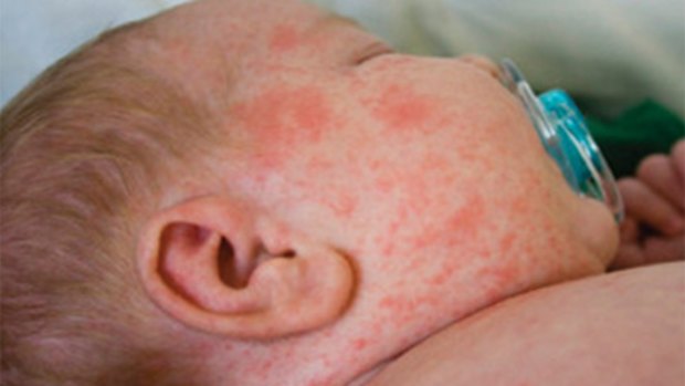 A rash is one of the symptoms of measles.