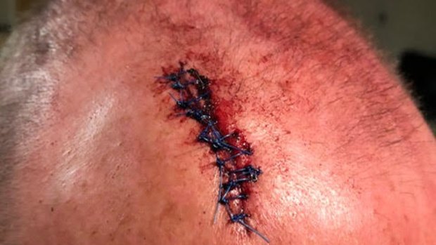 The police officer had to get 12 stitches after being hit from behind. 