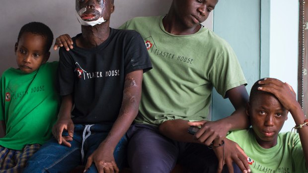 Justin, second from left, a teenager with severe burns with other children treated by the Plaster House. 