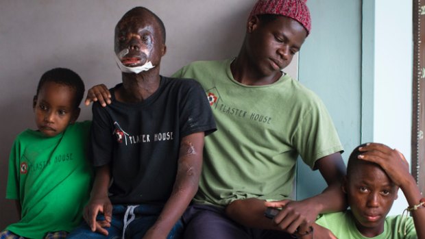 Justin, second from left, a teenager with severe burns with other children treated by the Plaster House. 