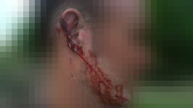 The injury suffered by a cyclist during a road rage attack on the Gold Coast. Photo: Queensland Police Service.