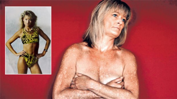 Gillian Penkethman as a young model before developing her condition, and showing her scars.