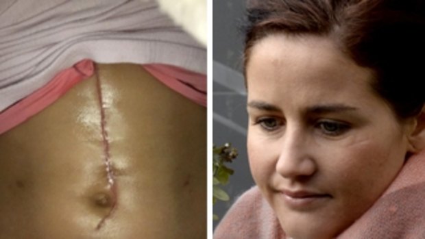Michelle Payne reveals the scar after surgery to repair her pancreas.