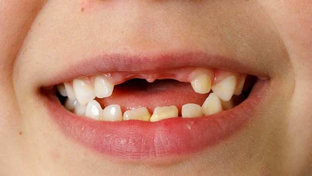 The number of decayed, missing and filled baby teeth was 46 per cent higher among children who consumed three or more sweet drinks a day.