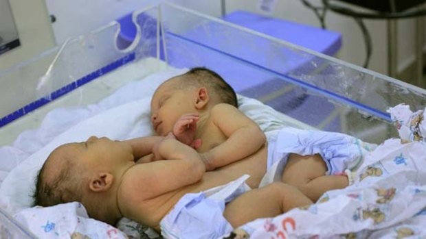 No rush … conjoined twins Teresa Maria and Maria Teresa will not be separated for nine months.