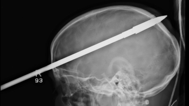 An X-ray showing the spear protruding from the front of Yasser Lopez's skull.