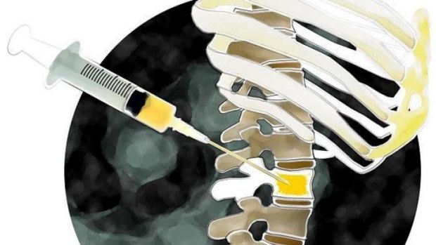 Researchers found treatment of central spinal stenosis in the lower back using epidural injections of steroids plus anaesthetic offered minimal or no short-term benefit as compared with anaesthetic alone.
