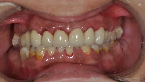After treatment, the teeth of the patient were improved enough to allow the patient to apply for jobs. 