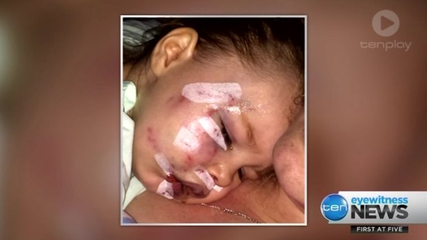 The Perth toddler required plastic surgery and nearly 50 stitches