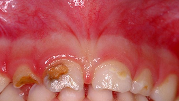 The discoloured patches on this three-year-old Perth child's teeth show the extent of decay and had to be fixed under a general anaesthetic.