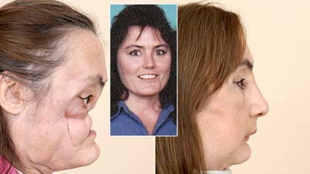 These photos, released by the Cleveland Clinic, show Connie Culp left, after the shotgun, blast, how she was before and how she looks after her face operation.
