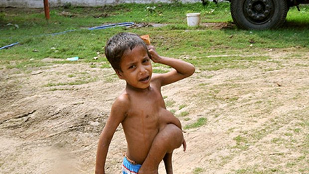 Deepak Kumar, 7, was born with four legs and arms growing from his torso from a parasitic twin.