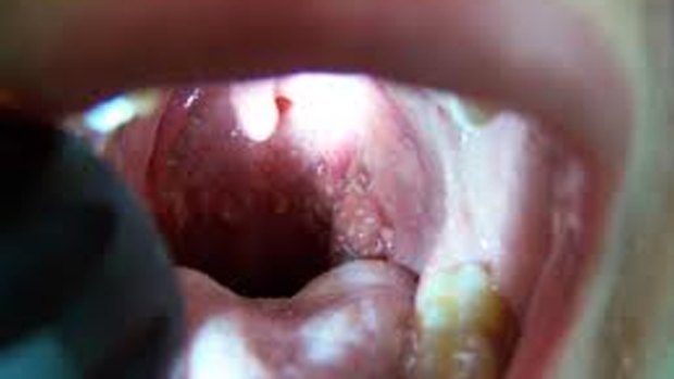 The A Streptococcal bacteria are often found in the throat and on the skin and can cause minor symptoms such as a sore throat.
