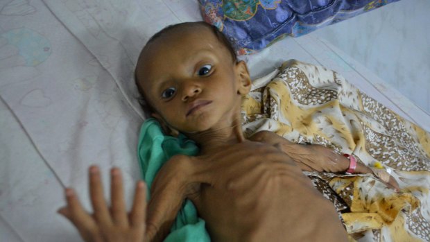 A boy who suffers from malnutrition lies on a bed at a hospital in Hodeidah, Yemen. Even before the war, Hodeidah was one of the poorest cities in Yemen.