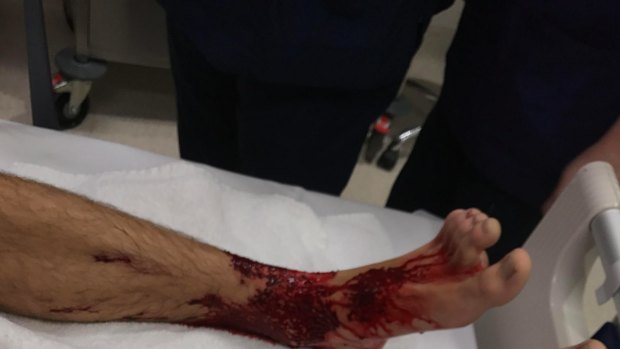 Creature from the deep? Or something else? Sam Kanizay's legs kept bleeding after a dip in the bay at Dendy Street beach in Brighton. Pictured at Sandringham Hospital.   