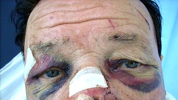 Mario Pesce was left nursing serious injuries after being brutally bashed in a home invasion.