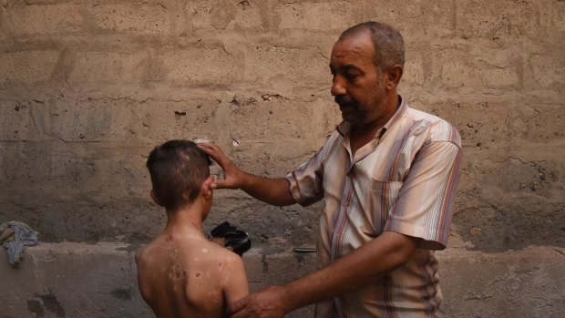 Nadhm Hamid shows the scars on his 11-year-old son Yaser caused by a chemical weapon that came through the roof of his home in Mosul. Experts have watched anxiously over the last three years for signs that Islamic State had discovered radioactive materials in the city.