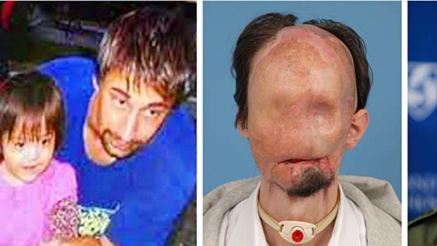 The way he was... Mr Wiens before the accident (left), before the transplant (centre), and after his surgery (right).
