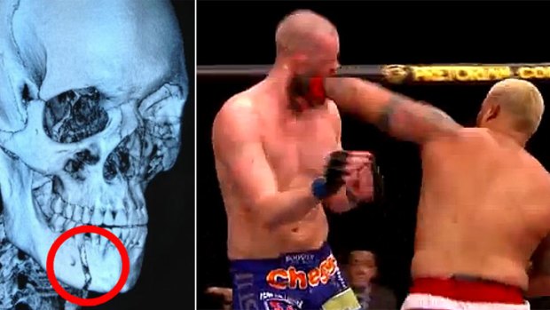 The x-ray of Stefan Struve's broken jaw (left) caused by this massive overhand left unleashed by Mark Hunt in March.