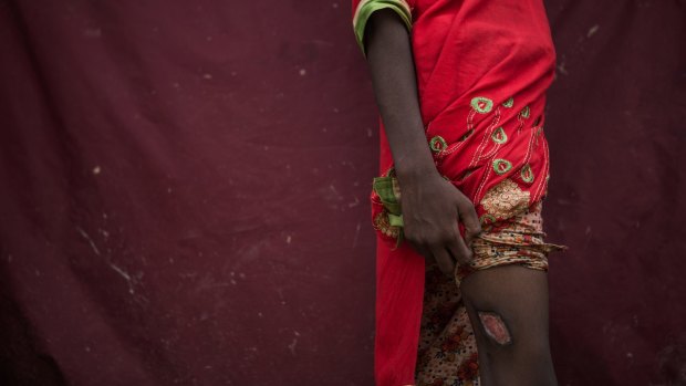 Fatima, 12, shows a scar from a gunshot wound she received a month earlier, when Myanmar Army soldiers surrounded her village and opened fire.