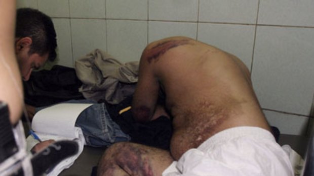 Abuse ... Iraqi policeman show signs of alleged torture in hospital in Baghdad.