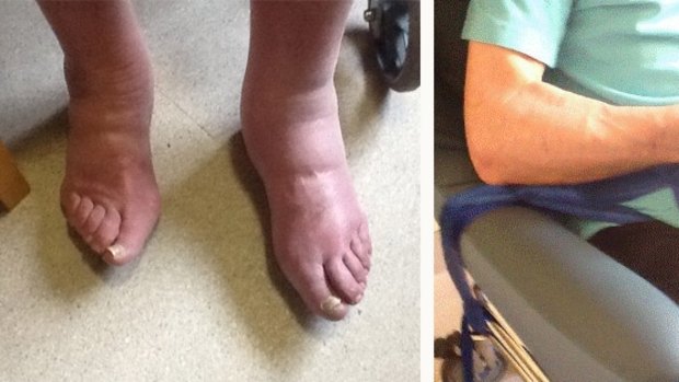 John Daly's swollen feet; strapped to a wheelchair.