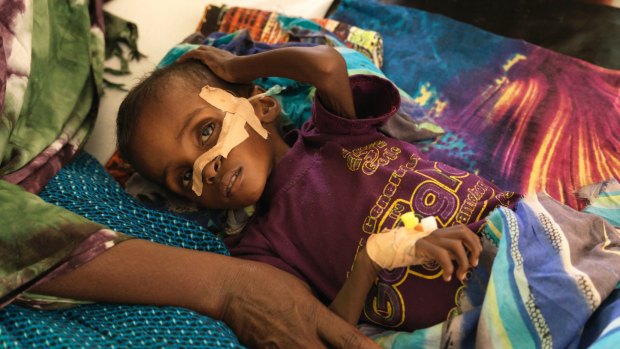 Niman Adan Gabush, 2, is a severe malnutrition case at Hargeisa Group Hospital.