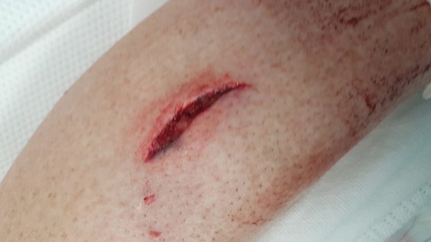 One of the bites Banks woman Kerry Evans sustained when she was attacked by a wombat.