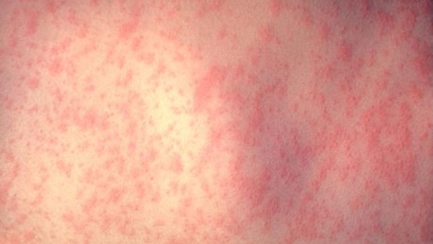 Two children and a woman have contracted measles and were infectious in western Sydney