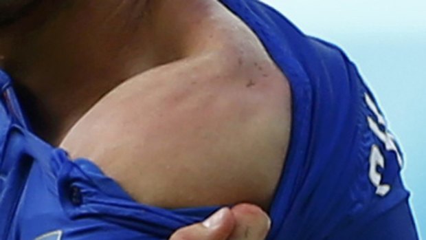 Suarez bite: Giorgio Chiellini reveals teeth marks on his shoulder.