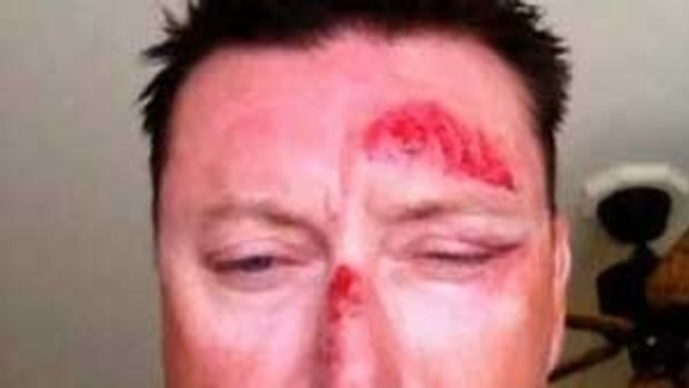 BIG SCARE: A photo showing Robert Allenby's injuries was aired on television.