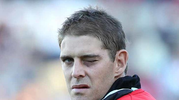Aaron Sandilands with a swollen left eye after getting injured.