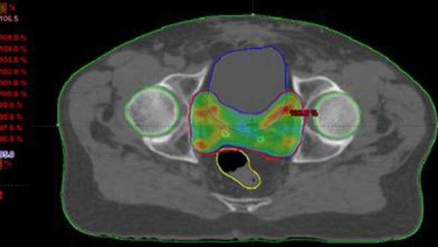 A CT scan of the prostate