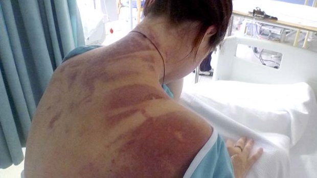 Erin Langworthy's injuries after she fell when the cord broke during her bungy jump at Victoria Falls in Zambia. Without travel insurance, she would have faced a bill for more than $50,000.
